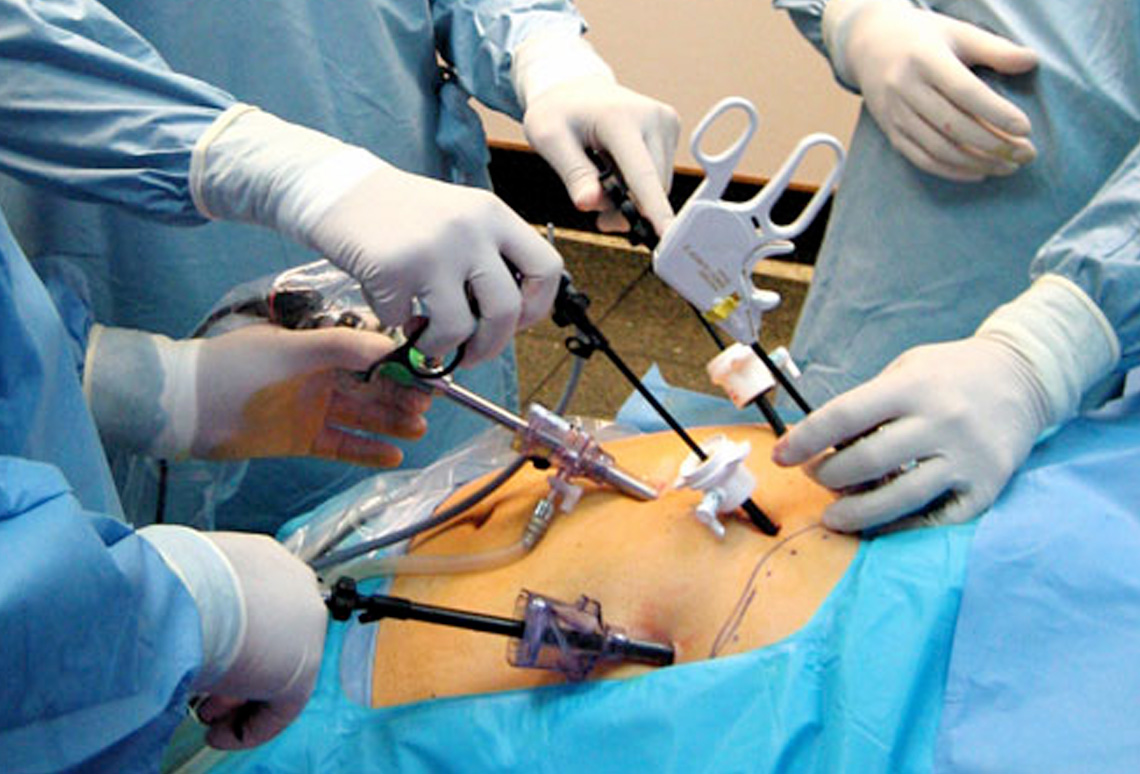 prostatectomia radical laparoscopica abordări moderne în tratamentul prostatitei